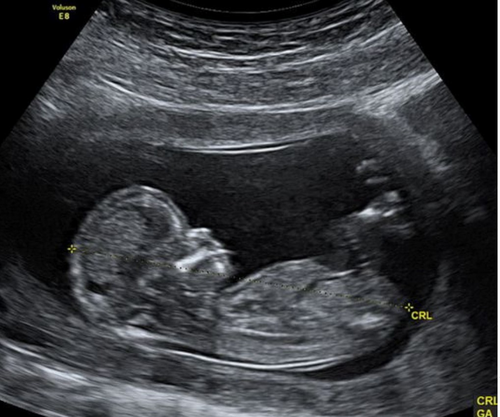 Ecografía de tamizaje genético