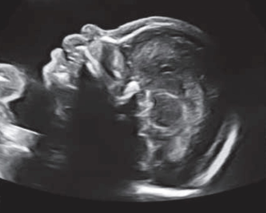 Ecografía semana 22