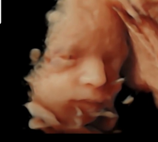 Ecografía de detalle anatómico